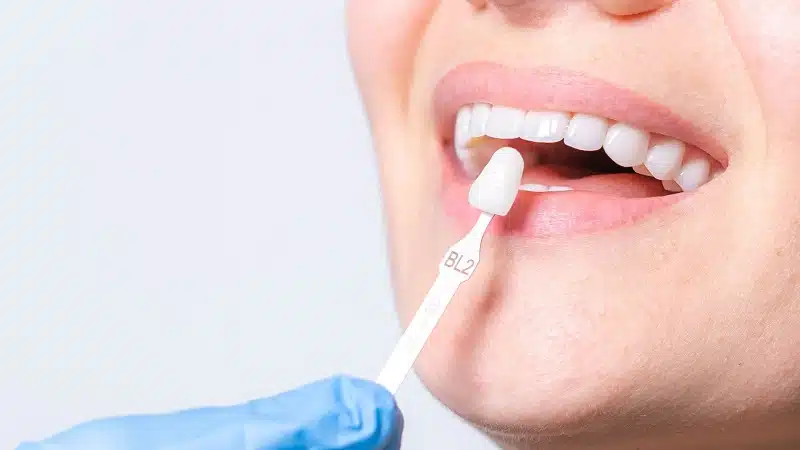 Alternatives aux implants dentaires : options et considérations